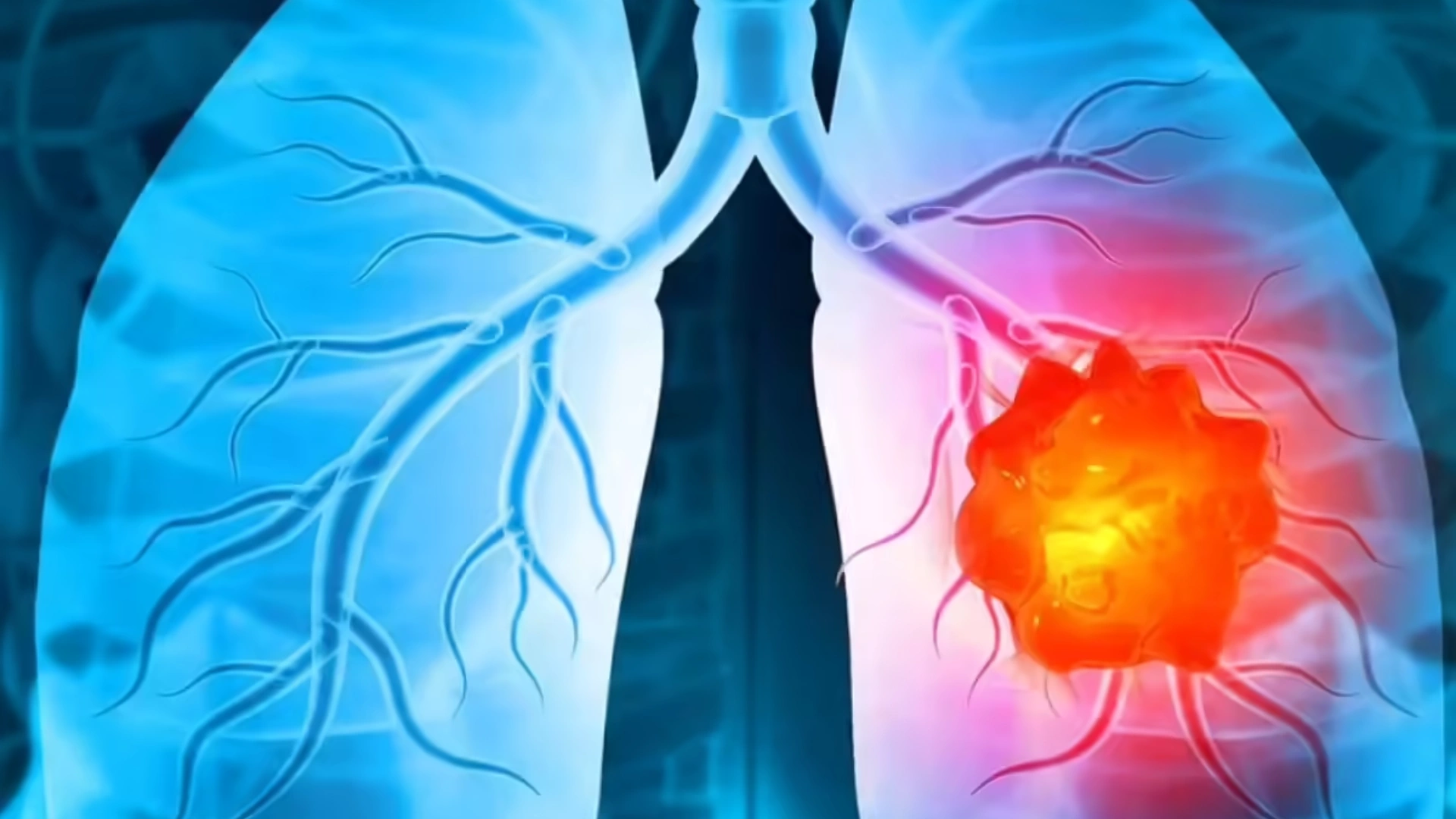 Experimental Antibody Drug Shows Early Promise Against Aggressive Lung Cancer