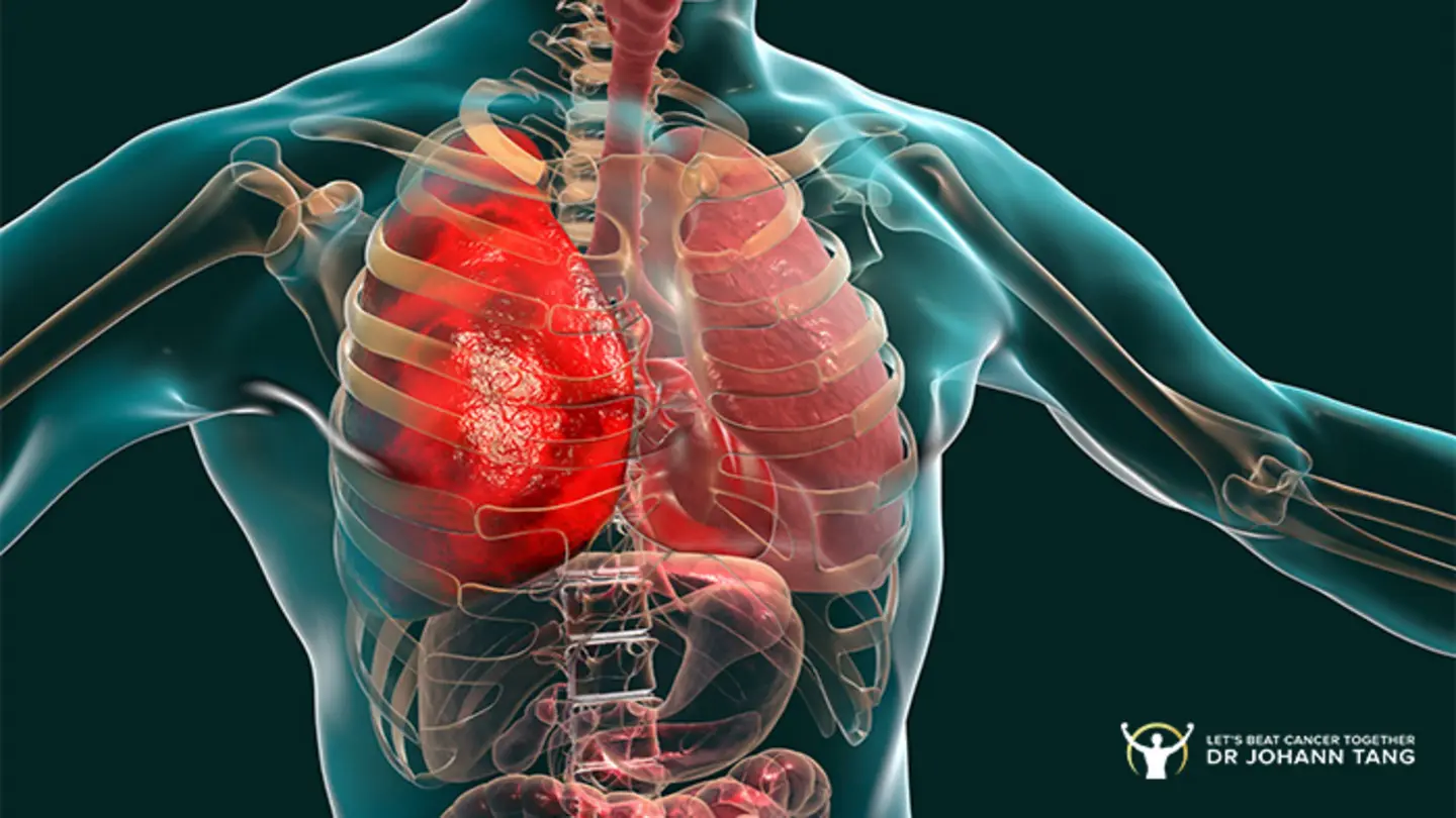 Beyond smoking: Lifestyle factors that raise lung cancer risk