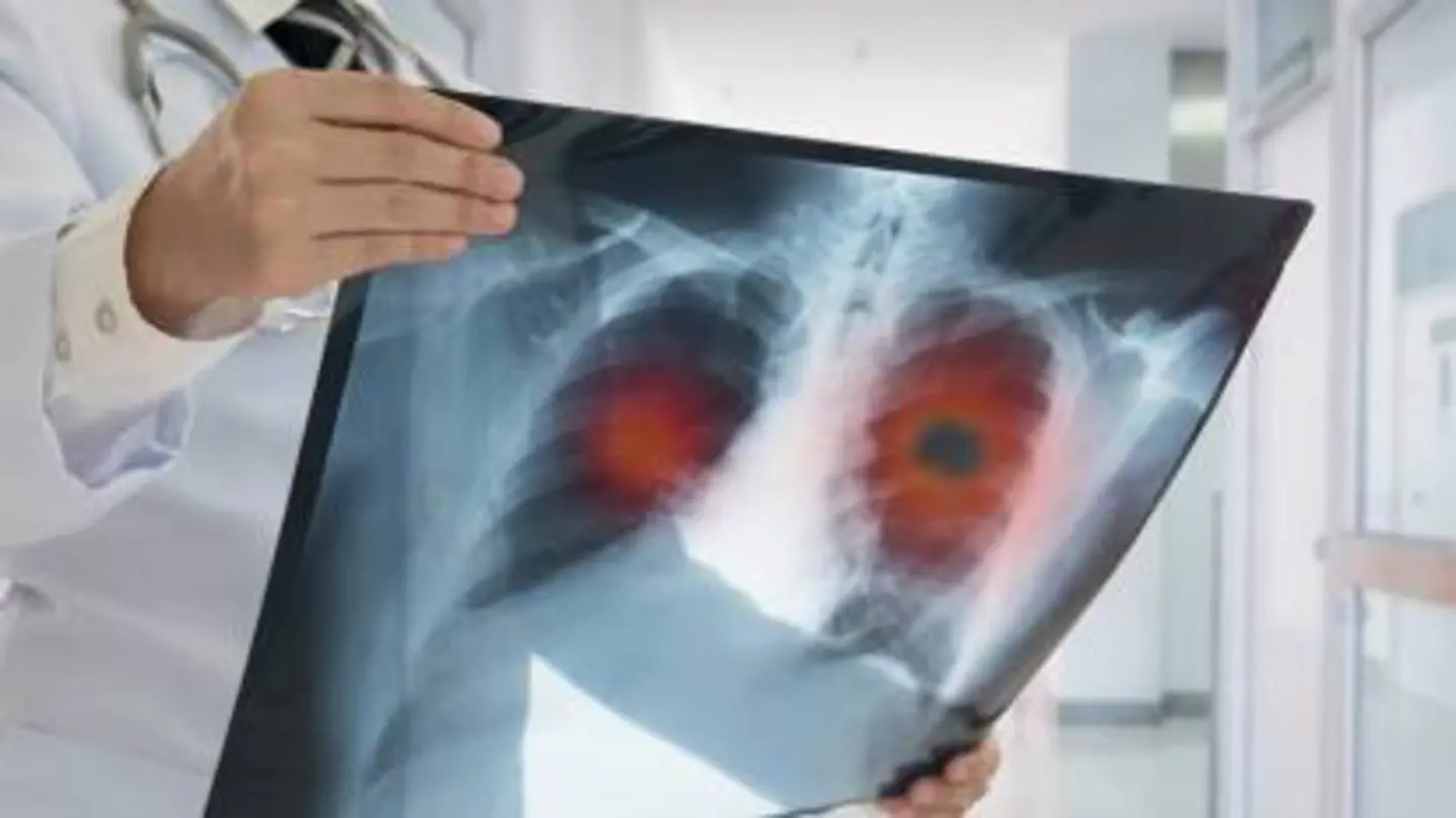 World Lung Day: Doctors warn women face higher lung damage risk
