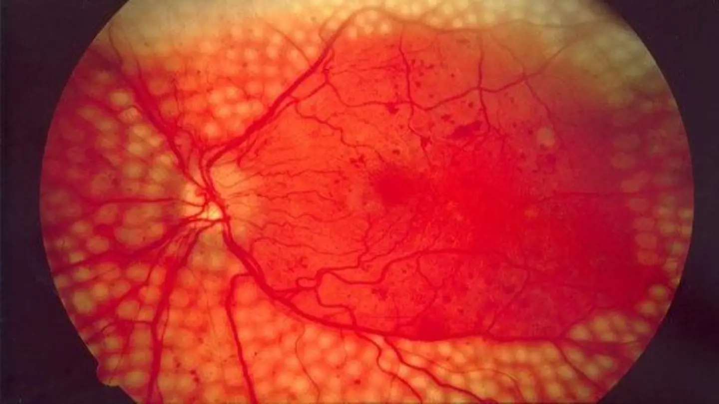 Diabetic Retinopathy: Screening Saves Sight, Yale Experts Say
