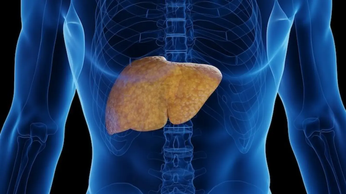 New Treatment Offers Hope for Deadly Fatty Liver Disease