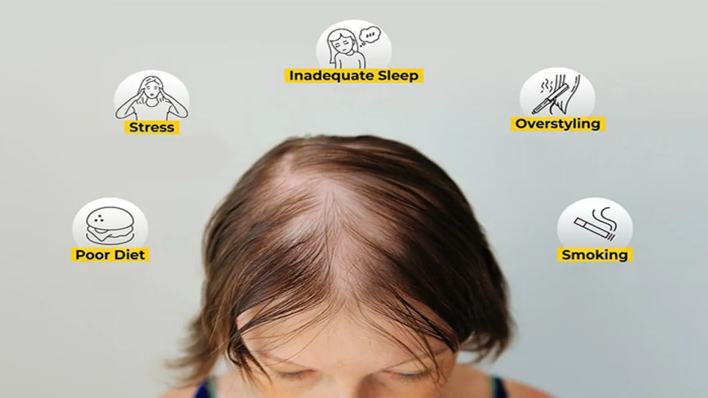 Lifestyle Mistakes Linked to Hair Loss: Times of India Report
