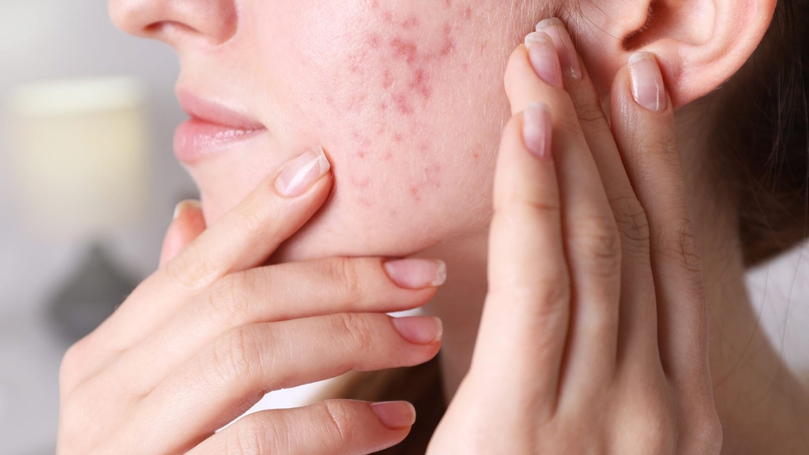 Gut imbalance signs on skin: 5 indicators you should know