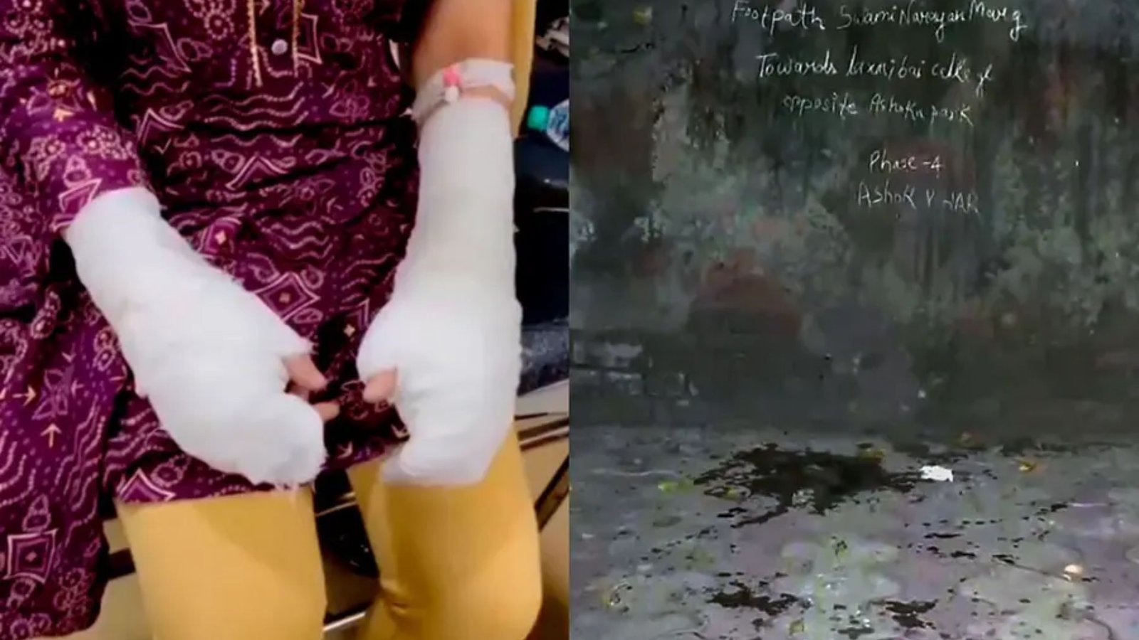 Delhi Acid Attack Case Takes Shocking Turn: DU Student’s Father Arrested, Cops Suspect Self-Inflicted Injuries