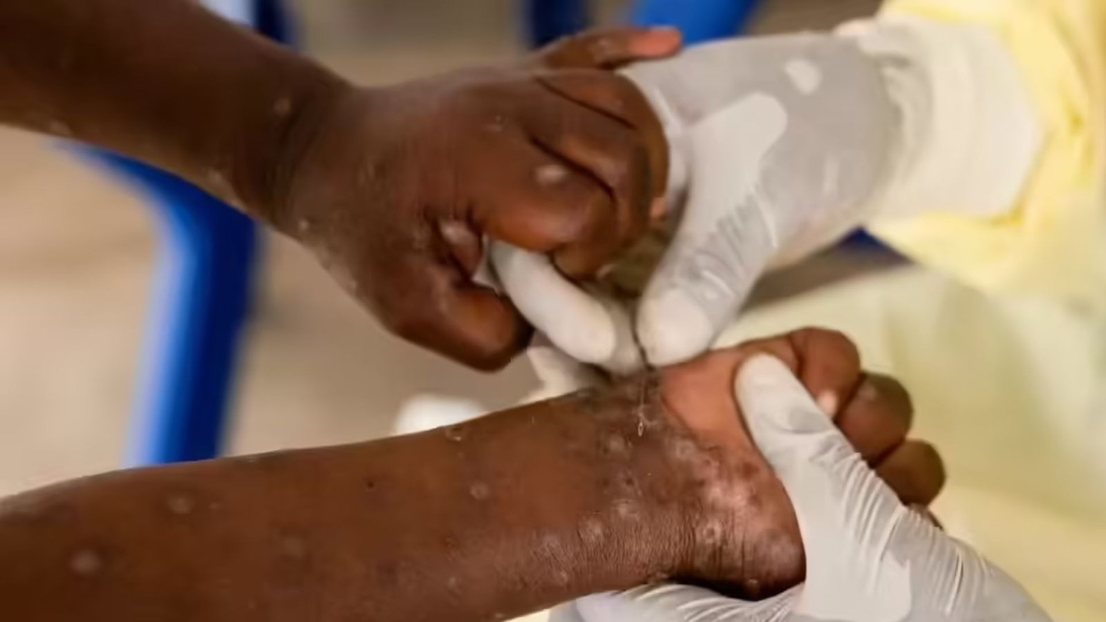 Severe mpox strain spreads in US: Stay safe, understand the risks.