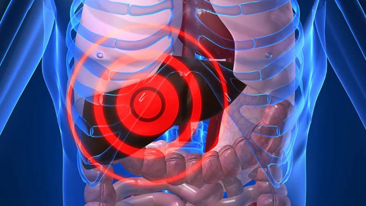 Noninvasive Tests May Predict Semaglutide Response in MASH: Medscape Report