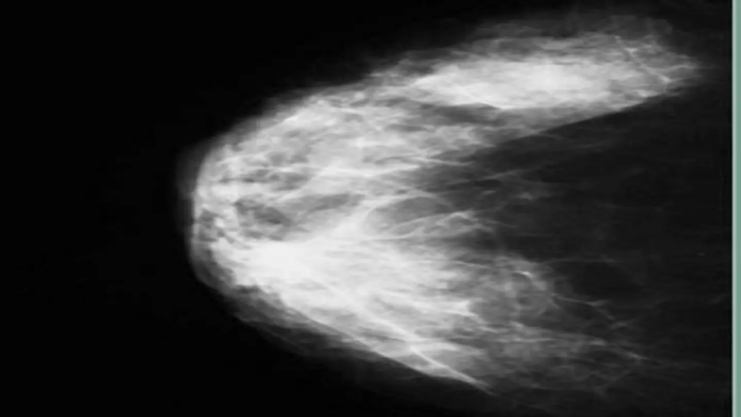 Dense Breasts and Cancer Risk: What You Need to Know