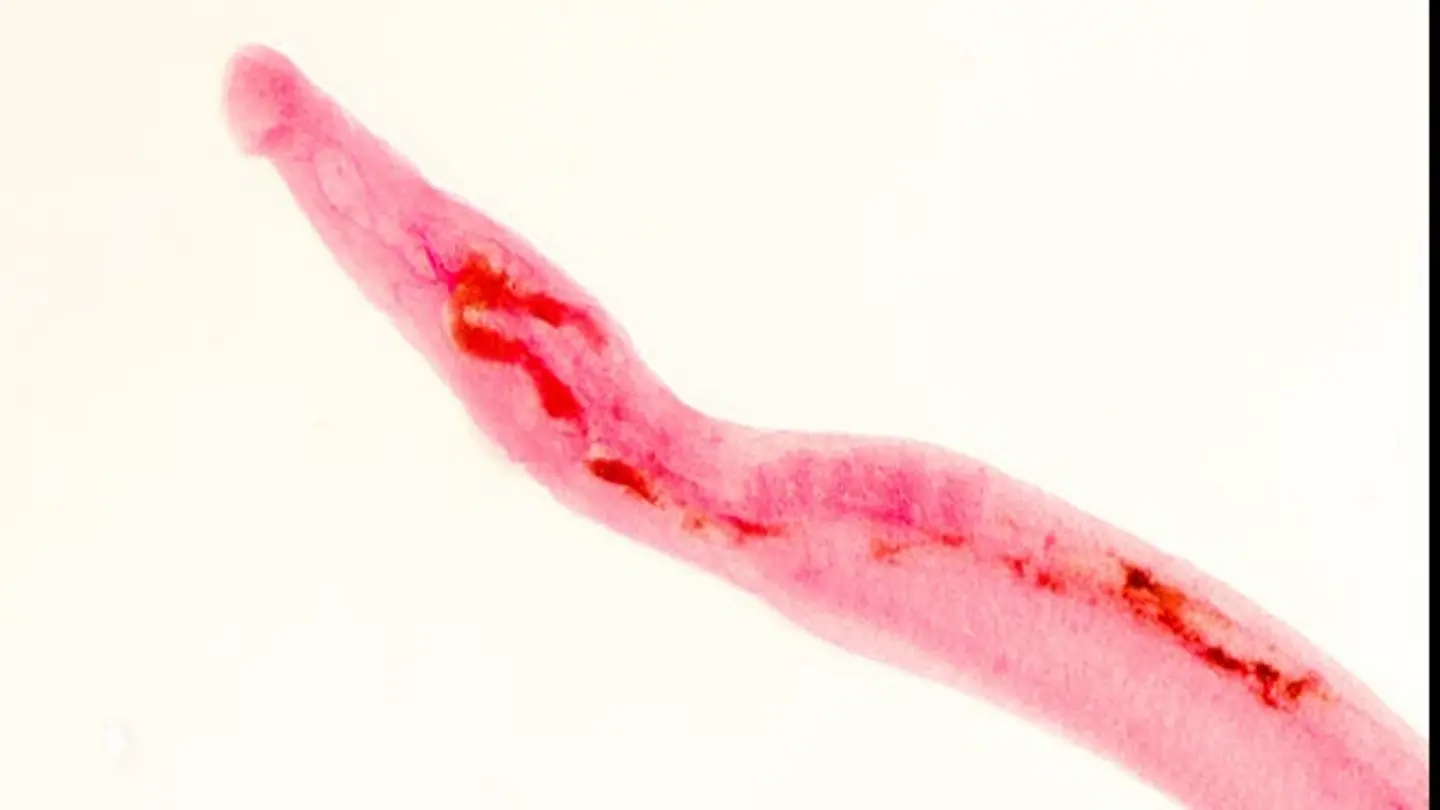 AI Significantly Improves Malaria Diagnosis Accuracy: New Study