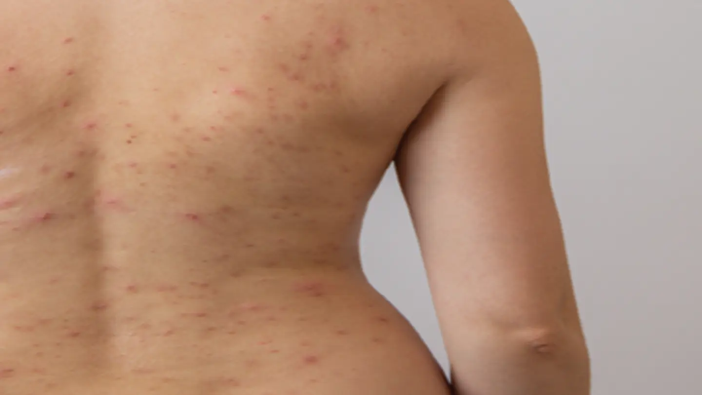 Decoding Cetuximab Response: Circ-EGFR Insights for Targeted Cancer Therapy