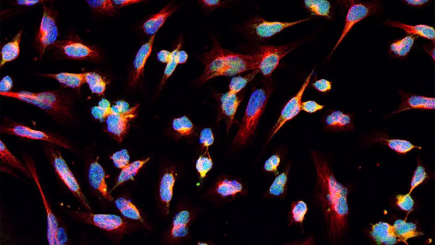 New Glioma Atlas Uncovers Brain Tumor’s Intricate Details