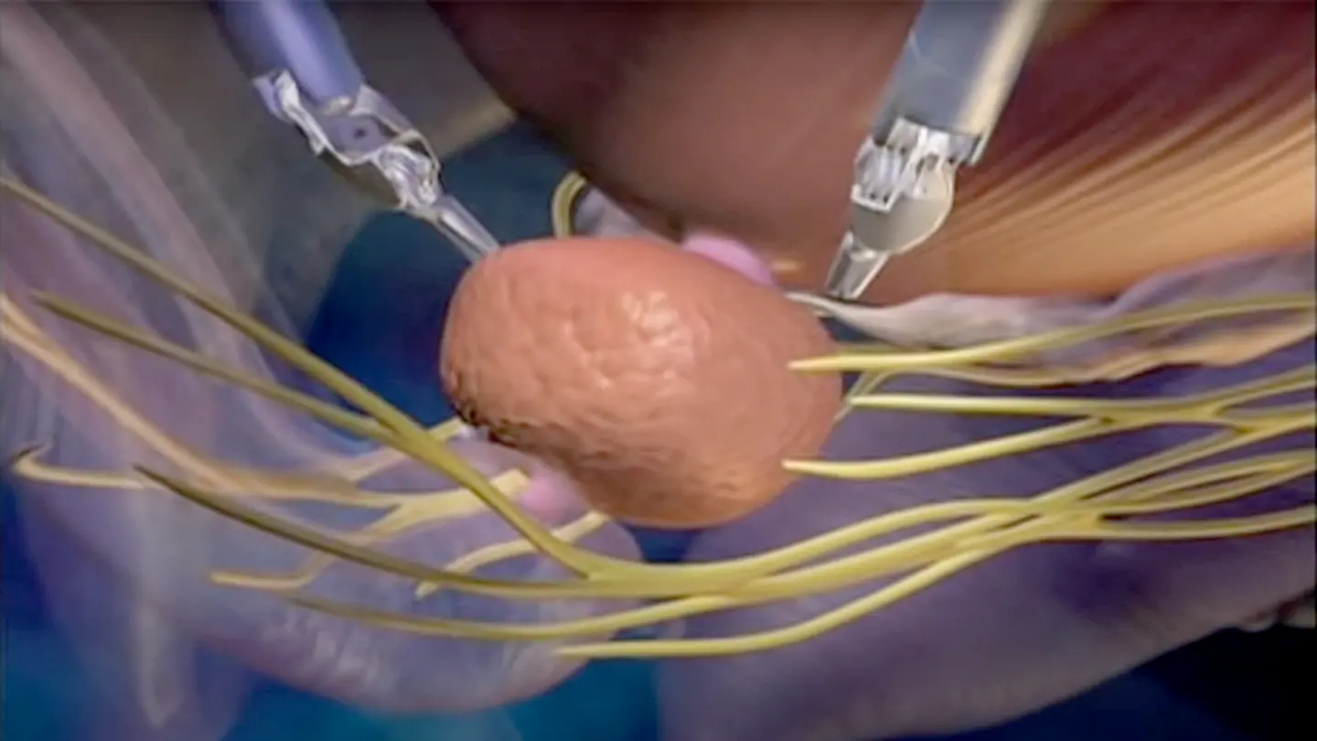 Robot-assisted prostatectomy shows fewer short-term complications, study finds