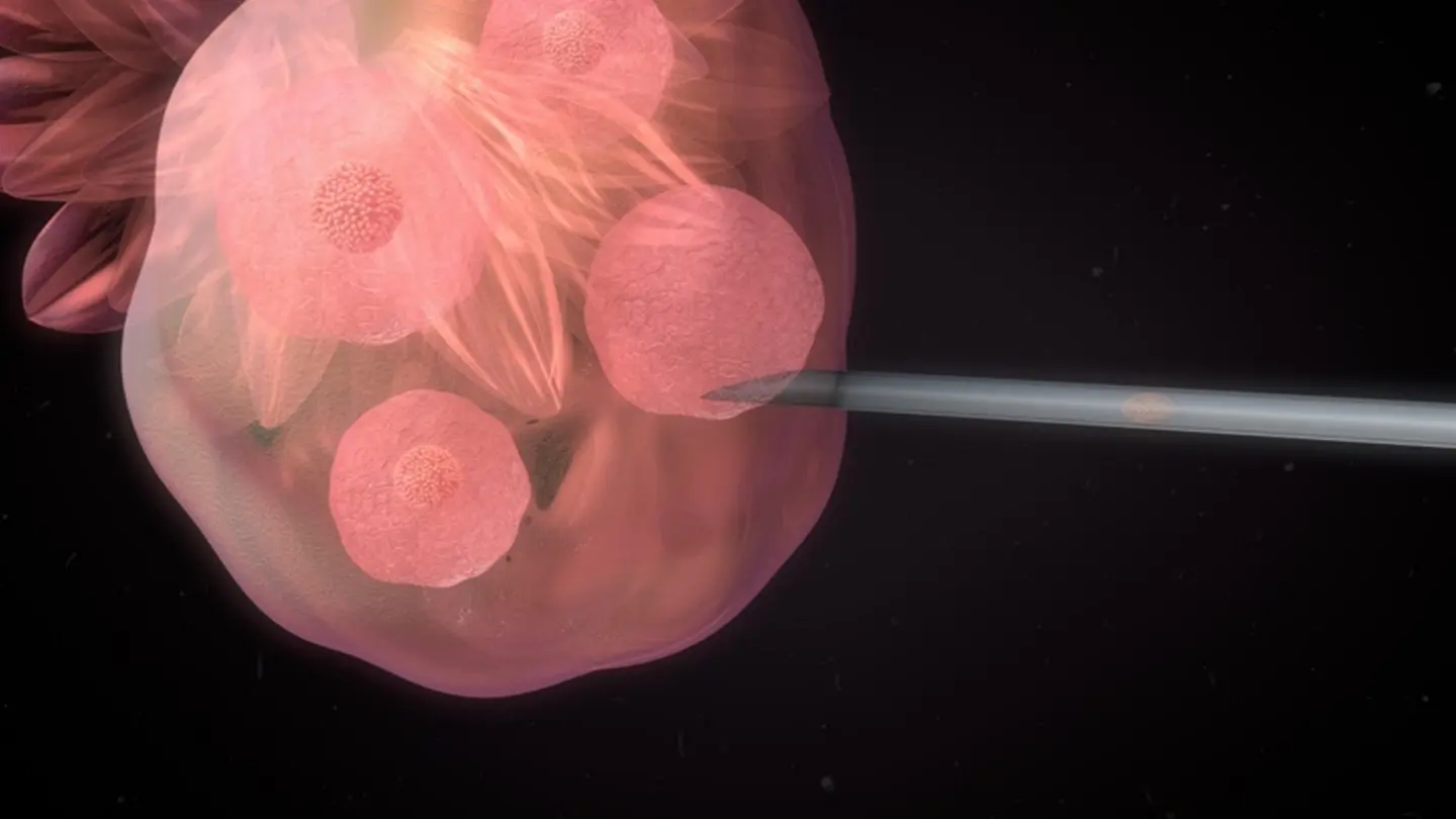 Low Testosterone Linked to Lower Sperm Retrieval Rates in Klinefelter Syndrome