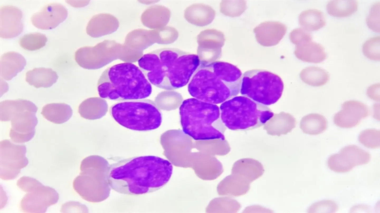Nomograms Predict Survival Rates in Acute Erythroid Leukemia