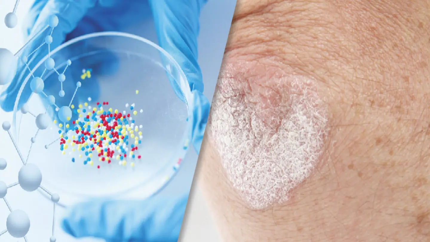 Real-World Data Backs Apremilast Efficacy in Psoriatic Disease