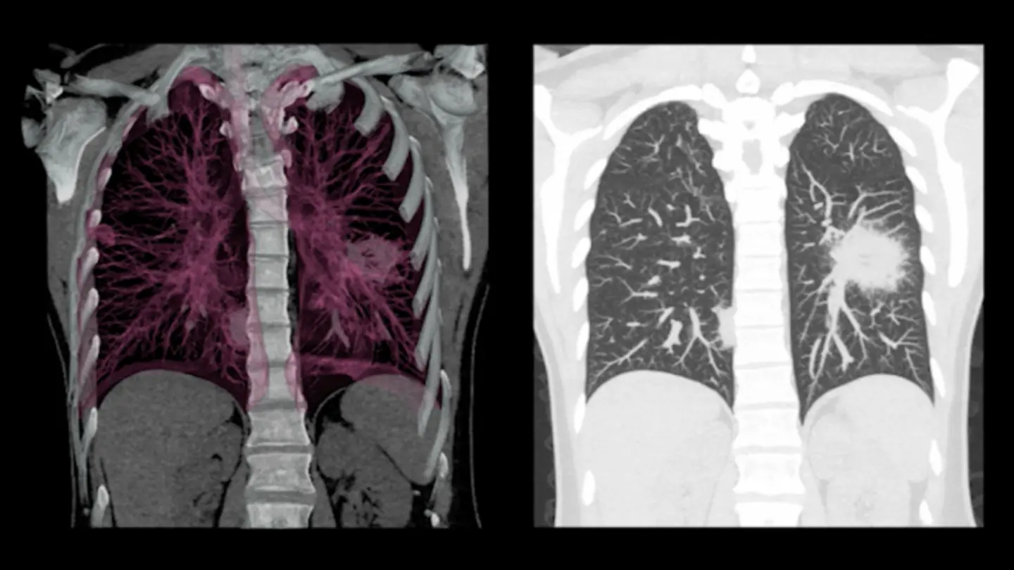 Lung Cancer Screening More Effective for Those Who Quit Smoking
