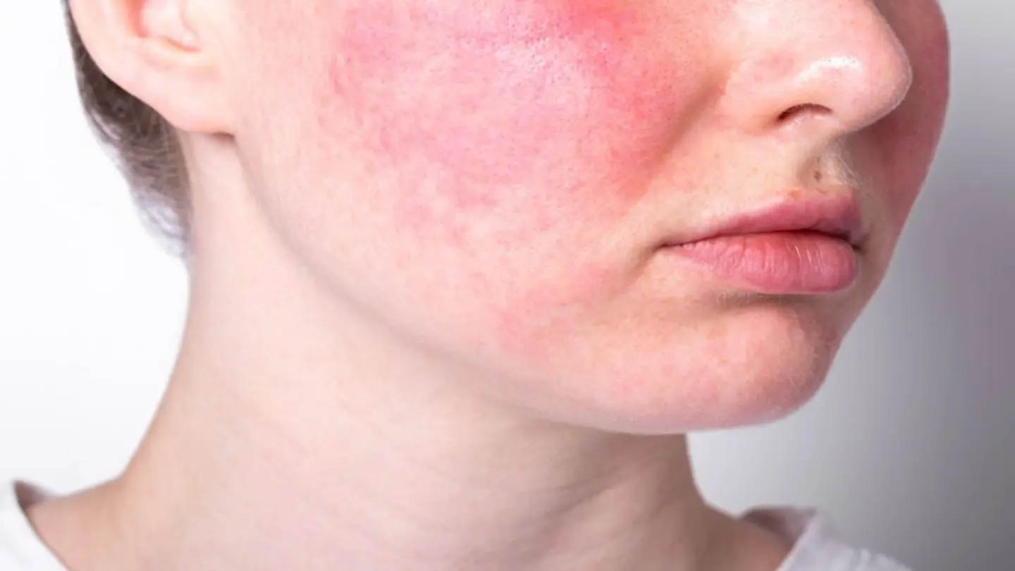 Antioxidant Intake Linked to Reduced Oxidative Stress in Rosacea