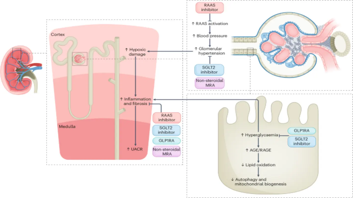 SGLT2 Inhibitors Reduce Kidney Disease Risk in Type 2 Diabetes Patients