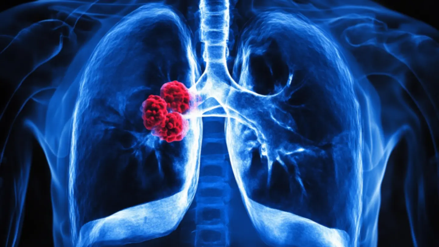 Childhood ILD Impacts Quality of Life: New Study Finds