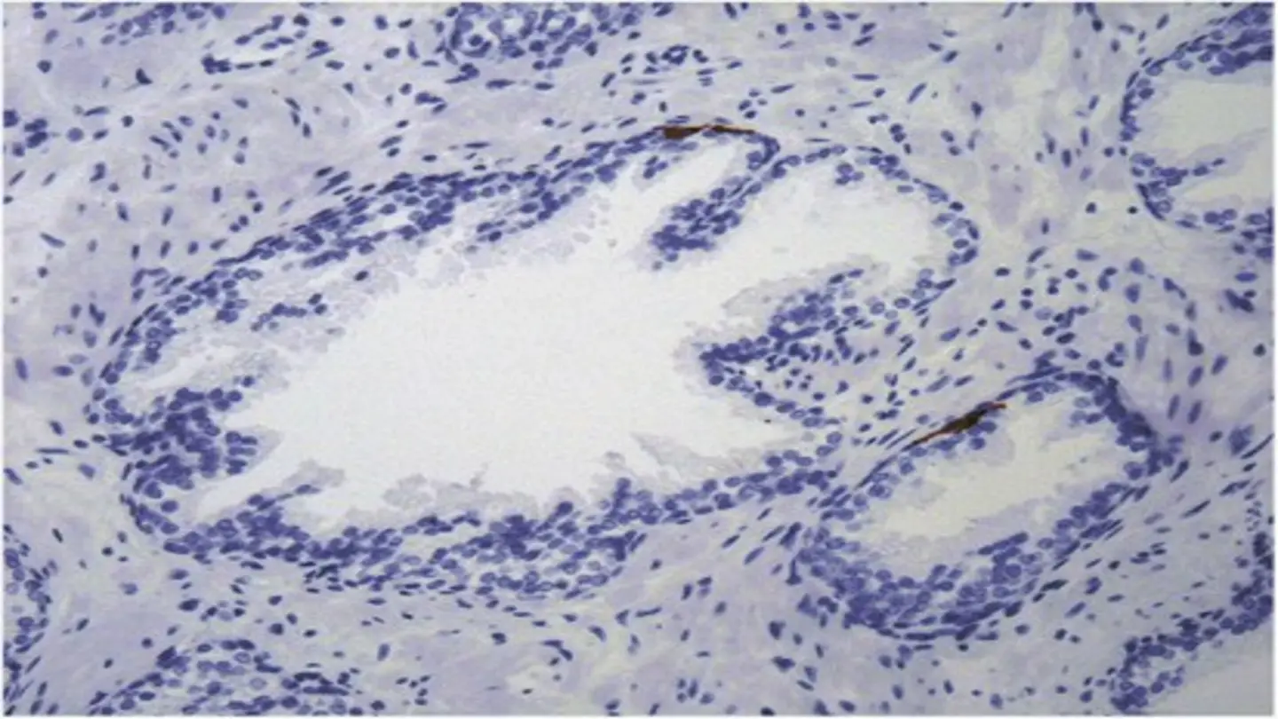 Biomarkers Offer Hope for Predicting Prostate Cancer Spread