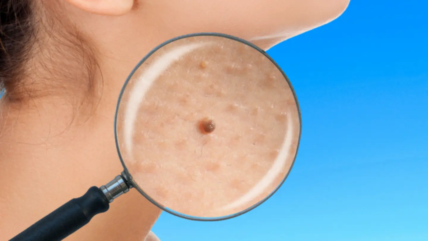 Skin Tags: Hidden Health Risks Unveiled by Veteran Neurosurgeon