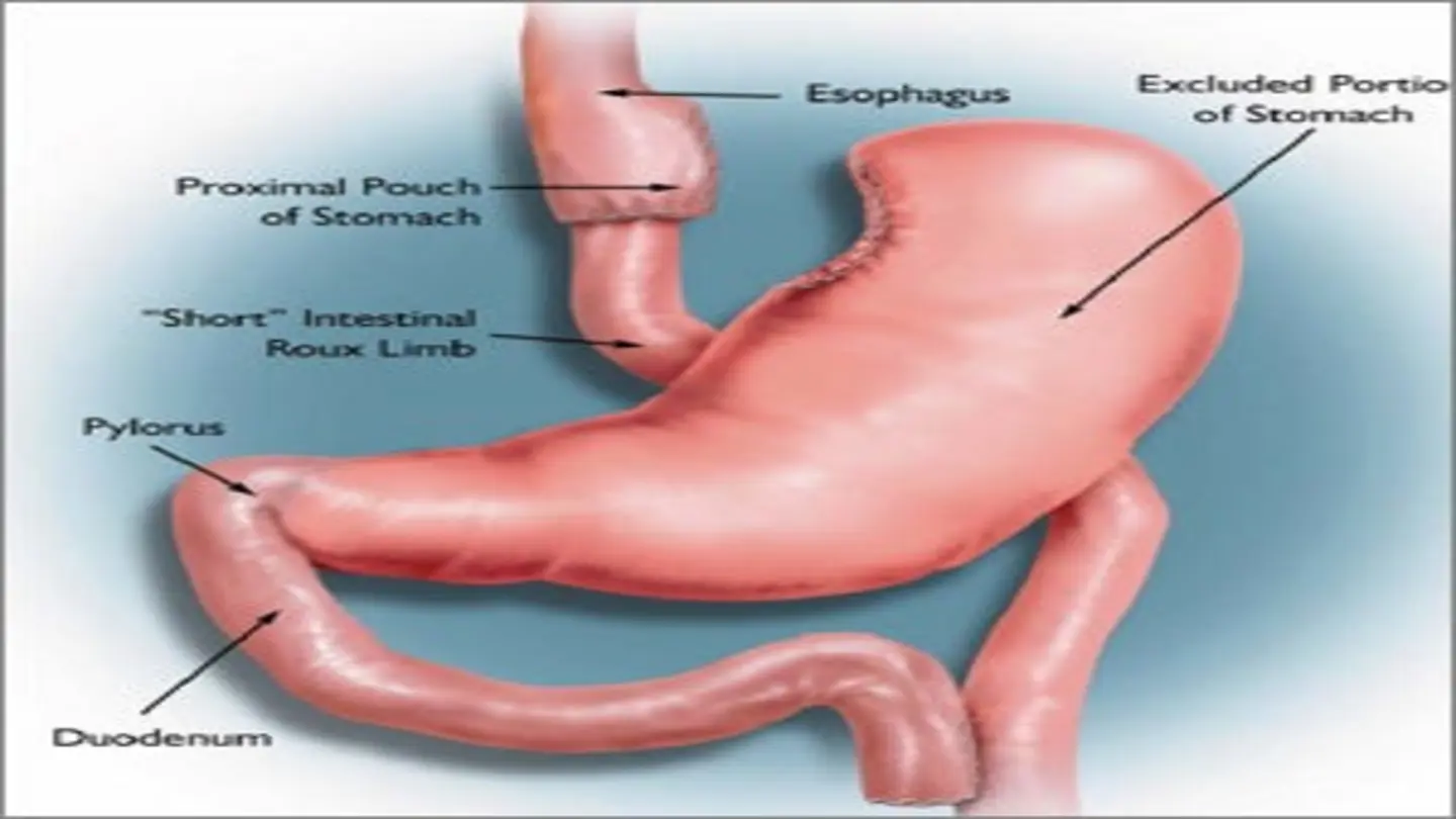 Gastric Bypass May Increase Risk of Stomach Cancer: Study